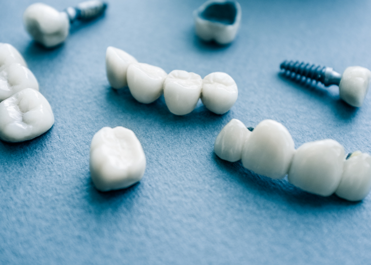 Implante dentário, como funciona?